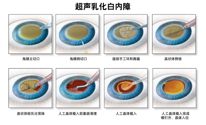 白内障超声乳化